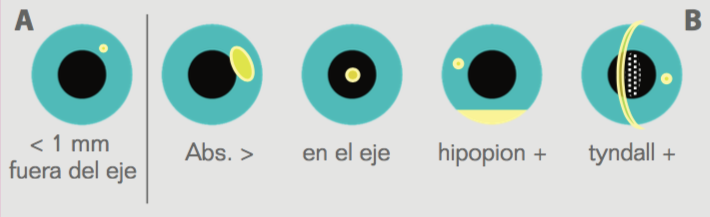 Absceso Corneal