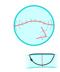 Penetrante corneal