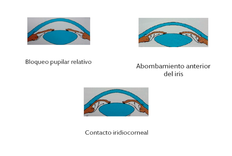 imagen glaucoma agudo