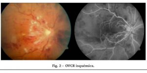 OVRC-Isquemica