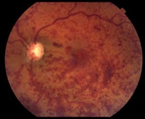 Oclusión Vena Central Retina-1