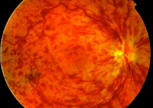 Oclusion Vena Central Retina 2